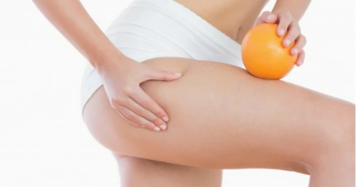 Timbul Stretch Marks Pada Perut Dan Paha Kenali Penyebabnya Glitzmedia Co